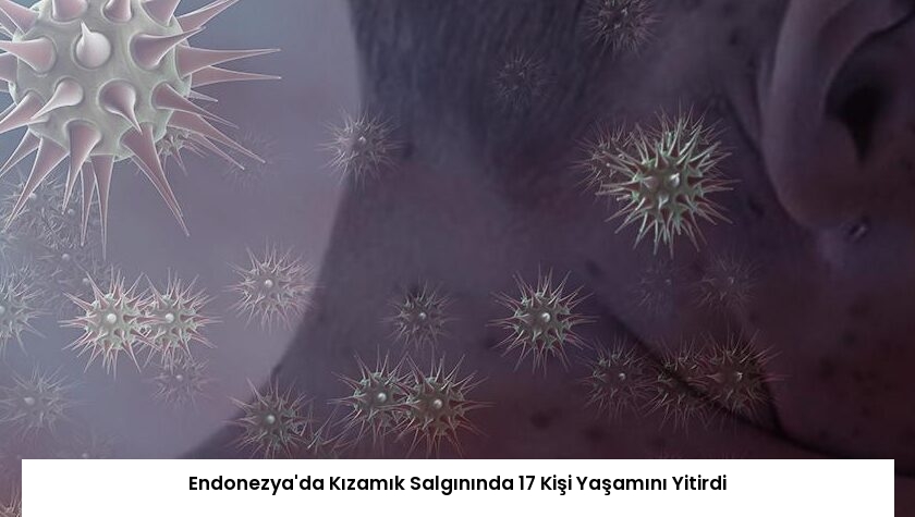 Endonezya’da Kızamık Salgınında 17 Kişi Yaşamını Yitirdi