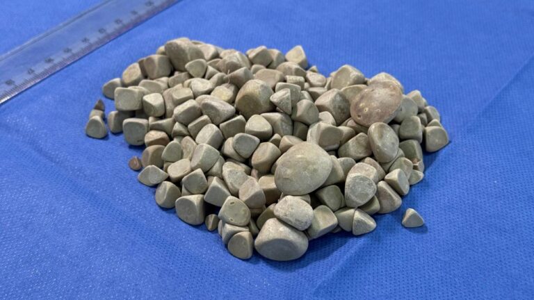 Vücudundan 287 Taş Çıkarılan Genç Kız