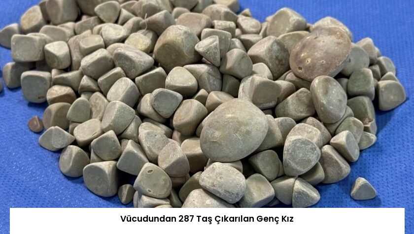 Vücudundan 287 Taş Çıkarılan Genç Kız