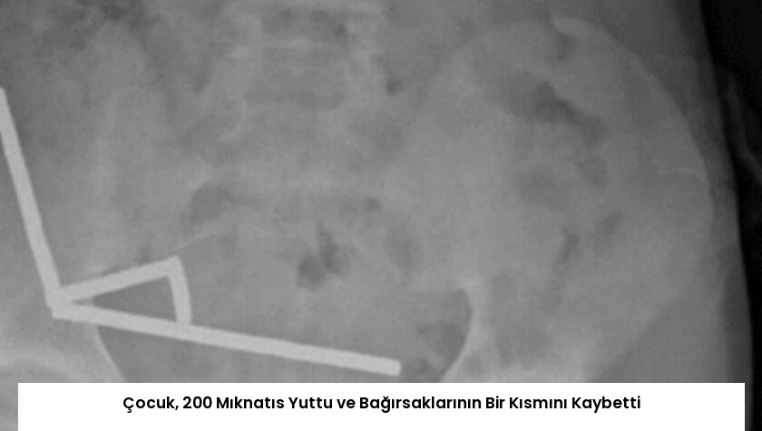 Çocuk, 200 Mıknatıs Yuttu ve Bağırsaklarının Bir Kısmını Kaybetti