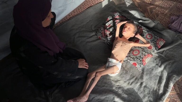 Gazzeli 10 yaşındaki Nafız açlıktan 8 kiloya düştü