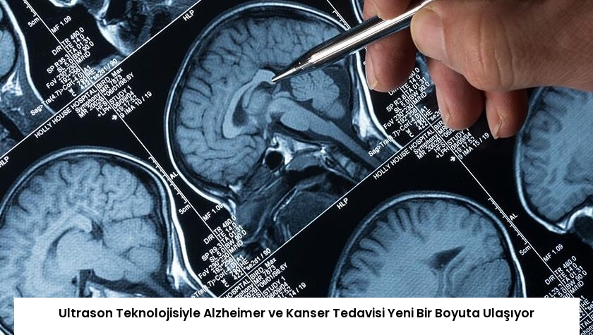 Ultrason Teknolojisiyle Alzheimer ve Kanser Tedavisi Yeni Bir Boyuta Ulaşıyor