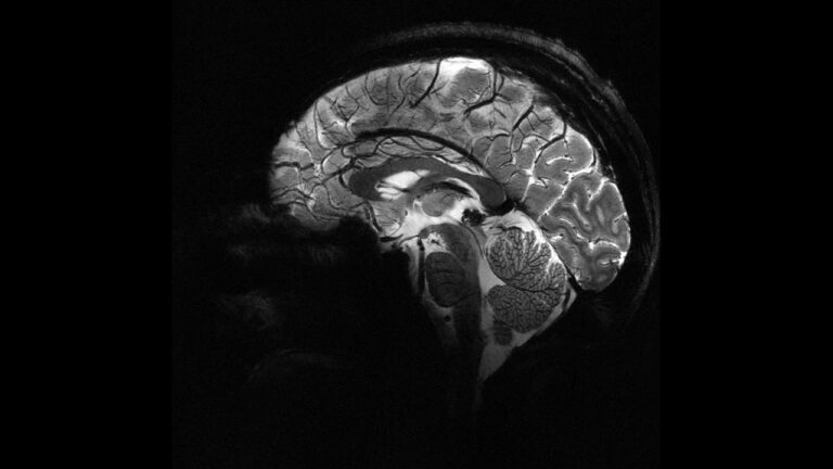 Yapay Zeka, Epilepsili Çocuklarda Gözden Kaçan Lezyonları Tespit Ediyor