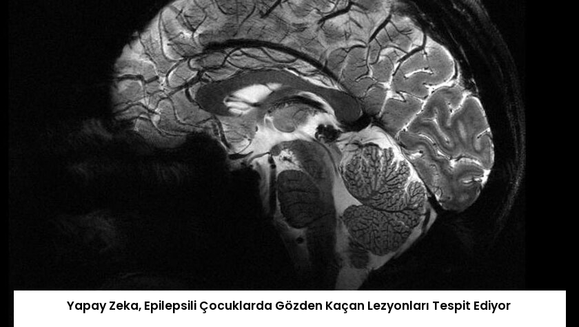 Yapay Zeka, Epilepsili Çocuklarda Gözden Kaçan Lezyonları Tespit Ediyor