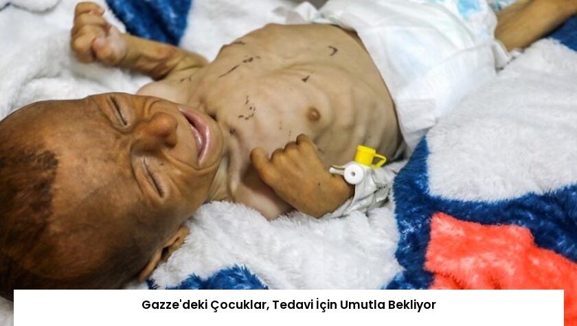 Gazze’deki Çocuklar, Tedavi İçin Umutla Bekliyor