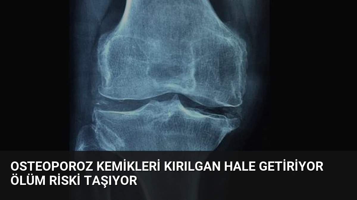 Osteoporoz Kemikleri Kırılgan Hale Getiriyor Ölüm Riski Taşıyor