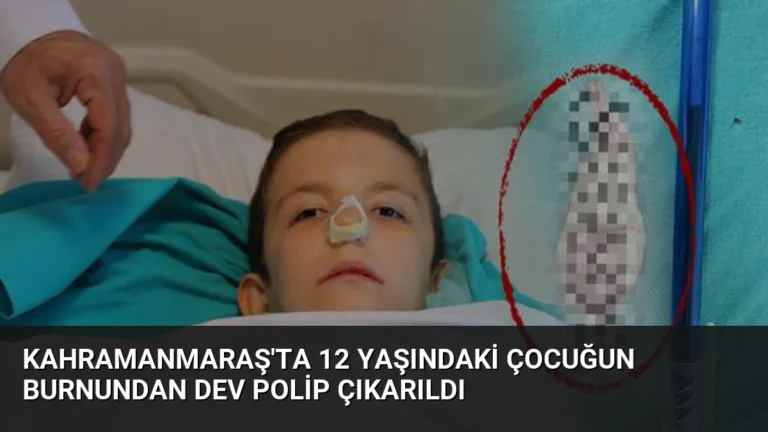 Kahramanmaraş’ta 12 Yaşındaki Çocuğun Burnundan Dev Polip Çıkarıldı
